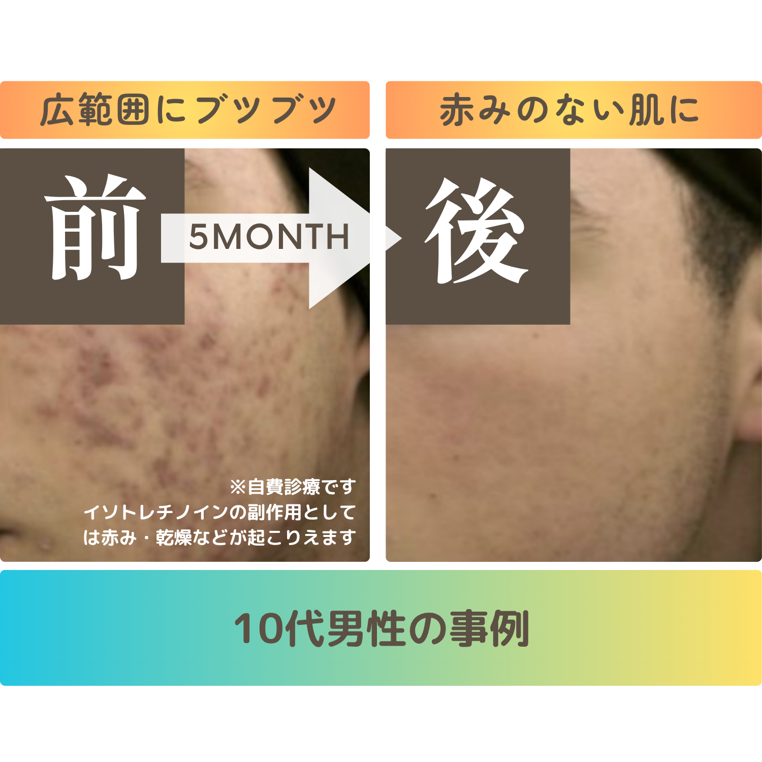 難治性ニキビ97%改善イソ