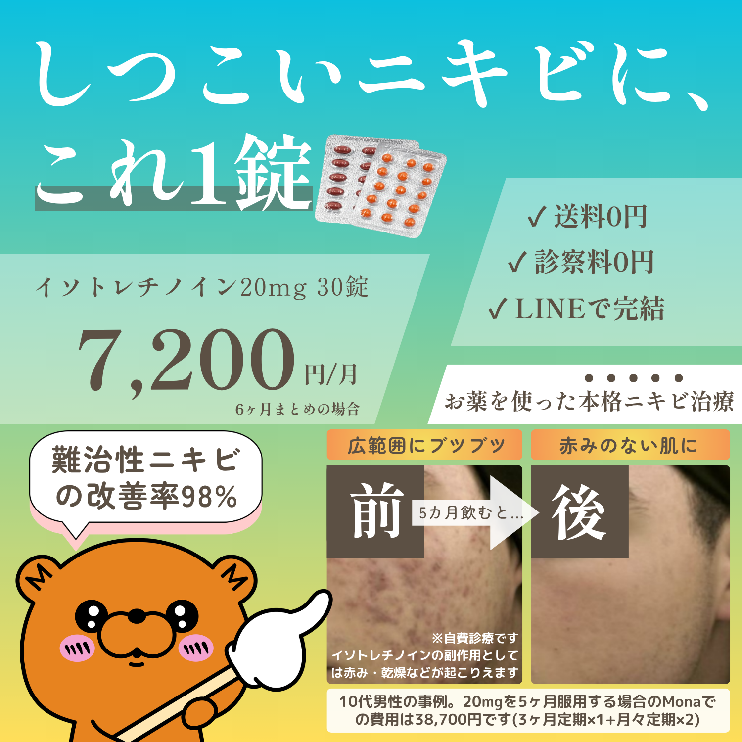 難治性ニキビ97%改善イソ